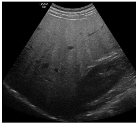 Ultrasound Of A Liver