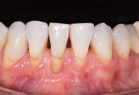 Tooth Recession 的图像结果