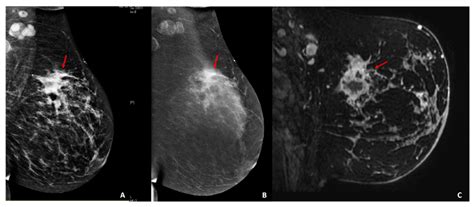 Radiomics for Tumor Characterization in Breast Cancer Patients: A ...