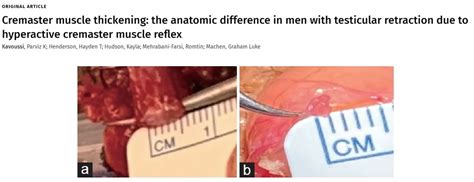 Image result for Cremaster Muscle Reflex