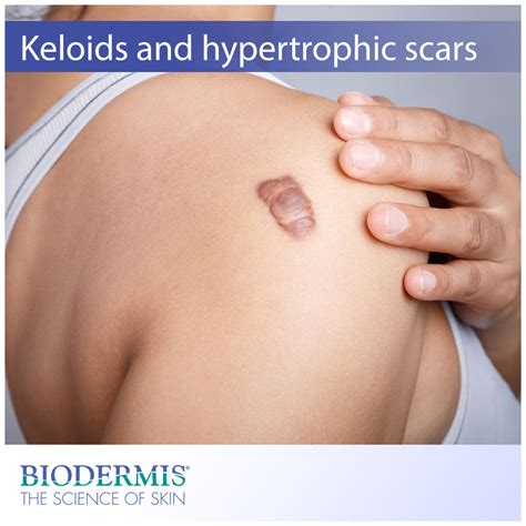 Keloid Scar Keloids / Hypertrophic Scars Dermatology Sydney