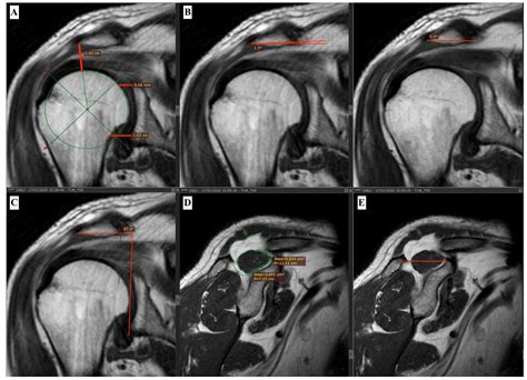 Shoulder Mri Without Contrast