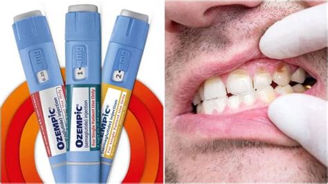 What are ‘Ozempic teeth’? Dentist shares shocking side effects of ...