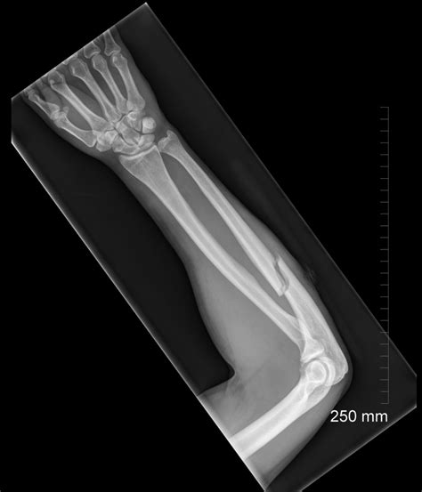 Ulnar bone fracture classification - wikidoc