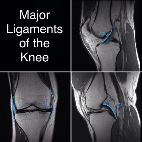 Normal knee ligaments. Anterior cruciate ACL, posterior cruciate PCL ...