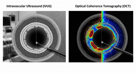 Intravascular Ultrasound (IVUS) and Optical Coherence Tomography (OCT ...
