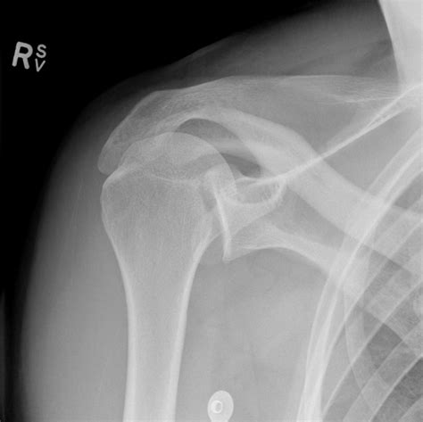 X Ray Shoulder Joint Dislocation at Paul Hunter blog