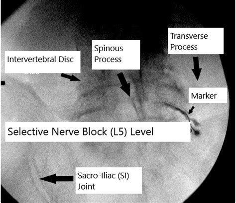 Image result for Selective Nerve Root Block