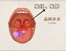Image result for 发炎