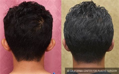 Image result for Ear Modification