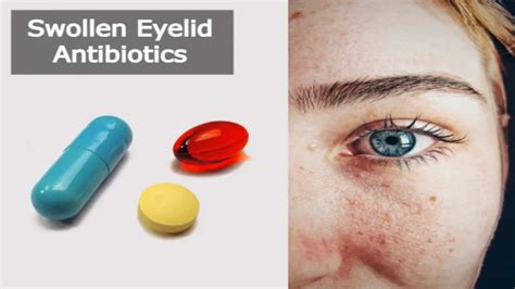 Can Antibiotics Treat a Swollen Eyelid? - Swollen Eyelid