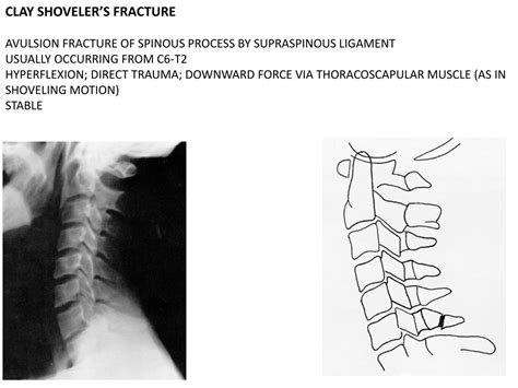 PPT - Spine Trauma: Imaging and Diagnosis Guidelines PowerPoint ...