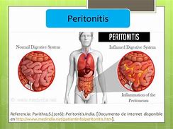 peritonitis 的图像结果