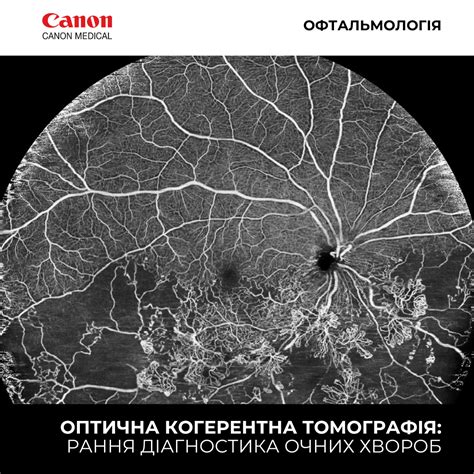 Оптична когерентна томографія: рання діагностика очних хвороб