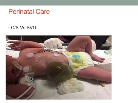 omphalocele and gastroschisis | PPTX