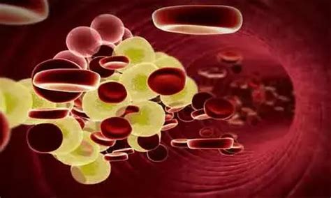 High ratio of fasting blood sugar to HDL-C tied to CV adverse events ...