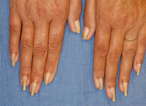 Fingernails - Ingrown fingernails - Dark Line - Fingernail Pain