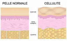 cellulite e alimentazione cos e la cellulite e perche firsystem aiuta ad eliminarla cellulite e alimentazione cos e la cellulite e perche firsystem aiuta ad eliminarla