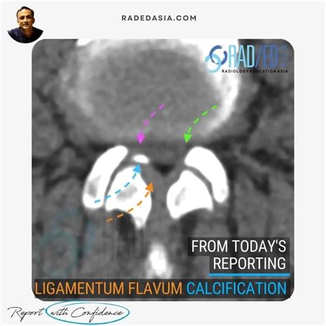 Ligamentum Flavum Hypertrophy Mri High Resolution, Three Dimensional