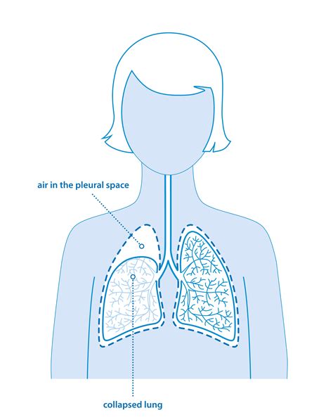 Pneumothorax (collapsed lung) | Asthma + Lung UK