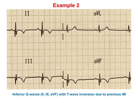 Q WAVE IN ECG,CAUSES OF PATHOLOGICAL Q WAVES | PPTX