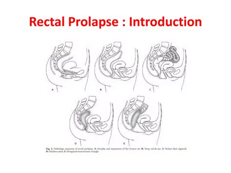 Rectal prolapse surgical approaches | PPTX