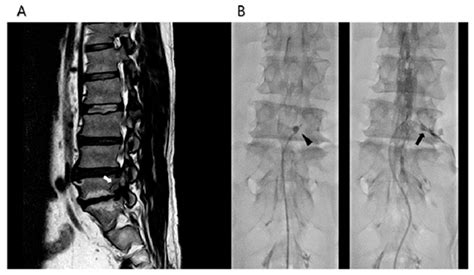 Factors Associated with Successful Response to Balloon Decompressive ...