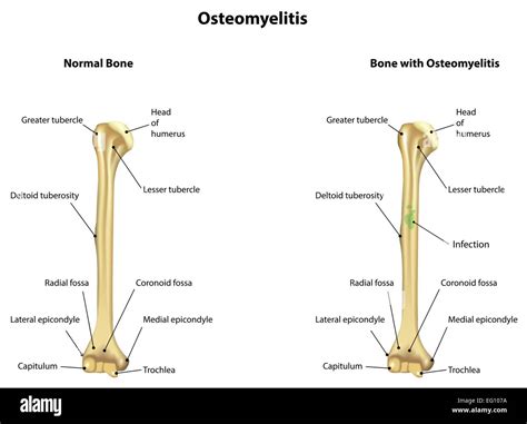 Trochlea Of Humerus Stock Vector Images - Alamy