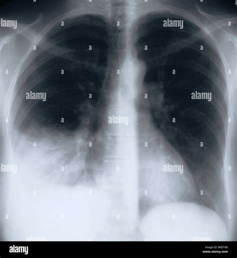 Bacterial Pneumonia Chest X Ray