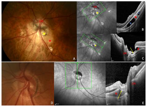 Peripapillary Intrachoroidal Cavitation