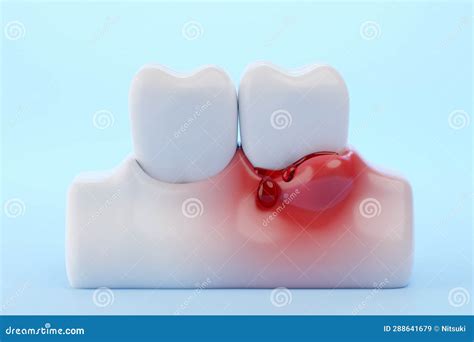 Bleeding Gums and Teeth Blue Background Stock Illustration - Illustration of recession, dental ...