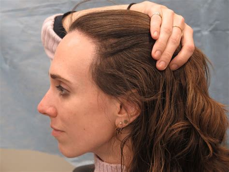 Receding Hairline in Women Signs, Causes, Reversal Surgery, Hair Transplant and Remedies ...