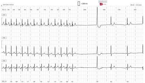 Sick sinus syndrome | ECG Guru - Instructor Resources