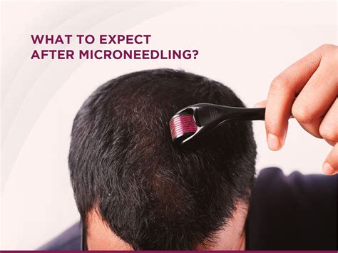 Microneedling for Hair: What to Expect During and After Treatment - Skin Solutionz