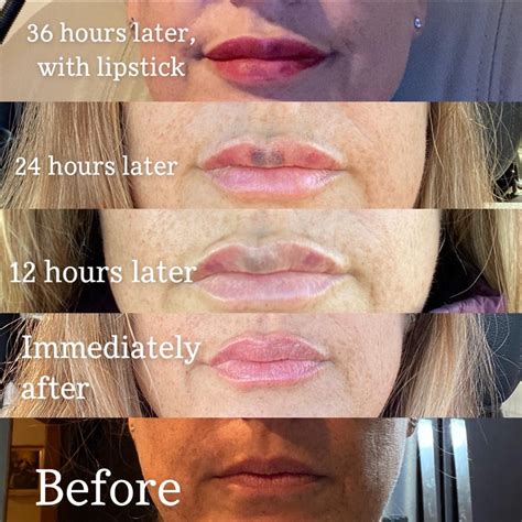 Juvederm lip injections over 36 hours : r/PlasticSurgery