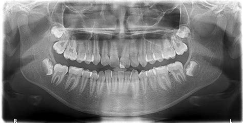 Дигитална Панорамна графия | Dental facts, Dentistry, Dental