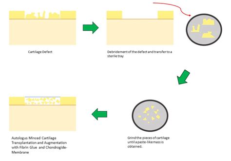 Minced Cartilage Is a One-Step Cartilage Repair Procedure for Small ...