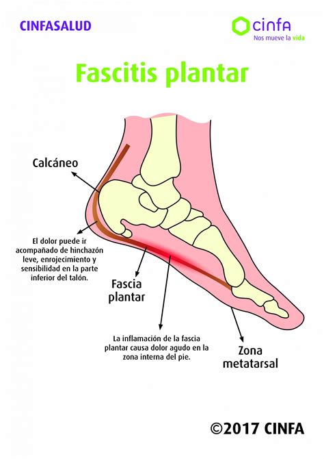 ¿Cómo se trata la fascitis plantar? | CinfaSalud