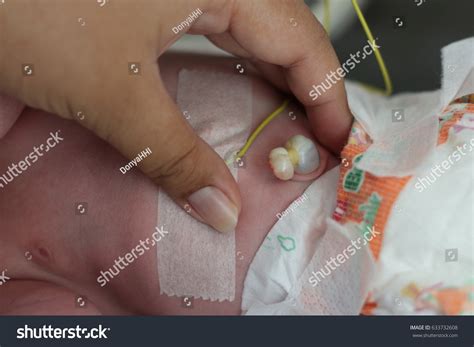 My Baby Umbilical Cord Is Bleeding at Carol Walsh blog