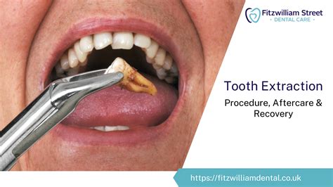 Recovery for Tooth Extraction 的图像结果