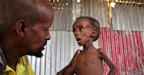 Study of Nutrition Crisis Finds Millions Either Malnourished or Obese
