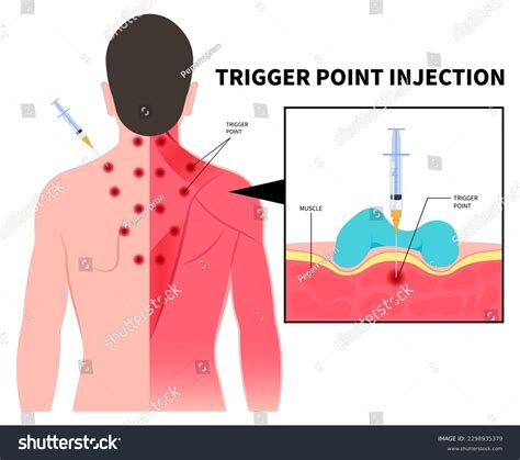 Fibromyalgia Trigger Points Diagram Fibromyalgia Trigger Points Tender