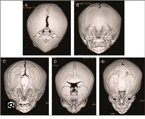 CT scans of an infant's skull before and after surgery to open up a ...