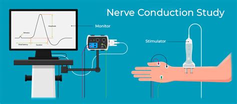 Image result for Repetitive nerve stimulation Nerve Conduction Study Procedure