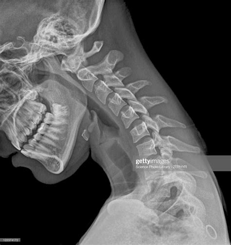 Normal flexed neck x ray of the flexed cervical spine of a 20 year ...