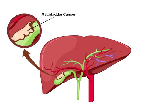 Image result for Gallbladder Cancer