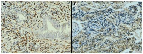 Estrogen Receptor (ER) and Progesterone Receptor (PgR) Expression in ...