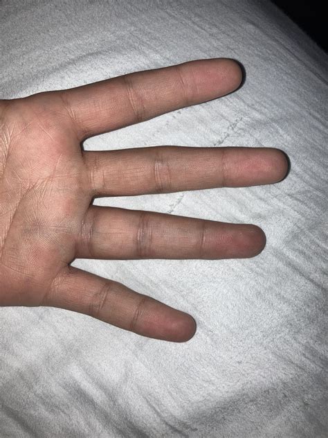 Is my finger broken or jammed/sprained? Ring finger specifically. : r ...