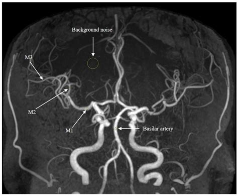 Deep Learning-Based High-Resolution Magnetic Resonance Angiography (MRA) Generation Model for 4D ...