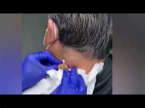 Largest Exploding Cyst 的图像结果